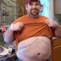 The Incision